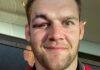 Today’s rugby news as Dan Lydiate reveals brutal facial injury and Jason Robinson backs Regan Grace to succeed